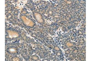The image on the left is immunohistochemistry of paraffin-embedded Human thyroid cancer tissue using ABIN7189588(ABCC12 Antibody) at dilution 1/10, on the right is treated with synthetic peptide.