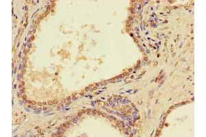 Immunohistochemistry of paraffin-embedded human prostate cancer using ABIN7162746 at dilution of 1:100 (PTCD2 抗体  (AA 153-388))