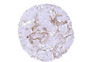 Breast Breast cancer NST with PD L1 negative tumor cells but intense PD L1 staining in tumor associated inflammatory cells (Recombinant PD-L1 抗体)