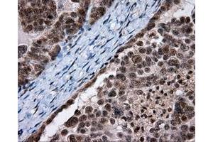 Immunohistochemical staining of paraffin-embedded Adenocarcinoma of breast tissue using anti-SRR mouse monoclonal antibody. (SRR 抗体)