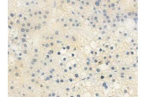ABIN6258591 and ABIN6275425 at 1/100 staining human hepatocellular carcinoma by IHC-P.