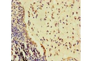 Immunohistochemistry of paraffin-embedded human lung cancer using ABIN7166936 at dilution of 1:100 (R-Spondin 3 抗体  (AA 22-272))