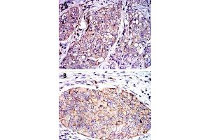 Immunohistochemical analysis of paraffin-embedded human lung cancer (A) and human kidney cancer (B) tissue using SERPINE1 monoclonal antobody, clone 1D5  with DAB staining. (PAI1 抗体)