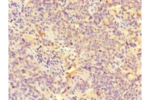 Immunohistochemistry of paraffin-embedded human cervical cancer using ABIN7163856 at dilution of 1:100 (GALNT11 抗体  (AA 420-606))