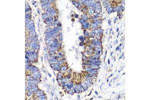 Immunohistochemistry of paraffin-embedded human colon carcinoma using RALB antibody (ABIN1682468, ABIN5664619, ABIN5664621 and ABIN6220484) at dilution of 1:100 (40x lens). (RALB 抗体  (AA 1-206))