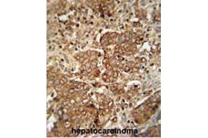 APCS antibody (C-term) immunohistochemistry analysis in formalin fixed and paraffin embedded human hepatocarcinoma followed by peroxidase conjugation of the secondary antibody and DAB staining. (APCS 抗体  (C-Term))