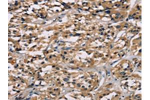 The image on the left is immunohistochemistry of paraffin-embedded Human thyroid cancer tissue using ABIN7128926(CGA Antibody) at dilution 1/65, on the right is treated with fusion protein. (CGA 抗体)