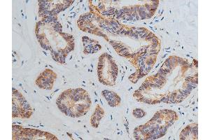 ABIN6269228 at 1/200 staining human breast cancer tissue sections by IHC-P. (VEGFR2/CD309 抗体)