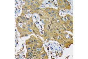 Immunohistochemistry of paraffin-embedded human lung cancer using RPB3/POLR2C Rabbit mAb (ABIN7269458) at dilution of 1:100 (40x lens). (POLR2C 抗体)