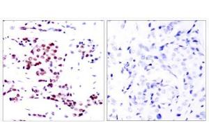 Immunohistochemical analysis of paraffin- embedded human breast carcinoma tissue using STAT5A (Ab-780) antibody (E021049). (STAT5A 抗体)