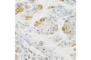 Immunohistochemistry of paraffin-embedded human uterine cancer using MLKL antibody (ABIN6134395, ABIN6143882, ABIN6143886 and ABIN6217454) at dilution of 1:100 (40x lens). (MLKL 抗体  (C-Term))
