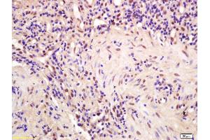 Formalin-fixed and paraffin embedded human gastric carcinoma labeled with Anti-CPSF4/CPSF30 Polyclonal Antibody, Unconjugated (ABIN1386751) at 1:200 followed by conjugation to the secondary antibody and DAB staining