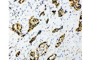IHC-P: Splicing factor 1 antibody testing of human lung cancer tissue (Splicing Factor 1 抗体  (N-Term))