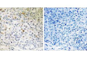 Peptide - +Immunohistochemistry analysis of paraffin-embedded human breast carcinoma tissue using CALML5 antibody. (CALML5 抗体)