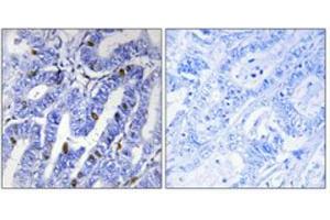 Immunohistochemical staining of human colon cancer (left). (PRKAR2B 抗体  (pSer113))