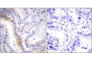 Immunohistochemistry analysis of paraffin-embedded human lung carcinoma tissue, using Urocortin Antibody. (Urocortin 抗体  (AA 71-120))