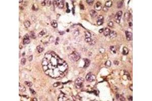 IHC analysis of FFPE human hepatocarcinoma tissue stained with the TAU antibody (tau 抗体  (AA 677-707))
