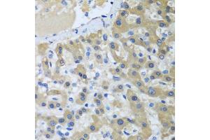 Immunohistochemistry of paraffin-embedded human liver cancer using XPC antibody (ABIN5974562) at dilution of 1/100 (40x lens). (XPC 抗体)