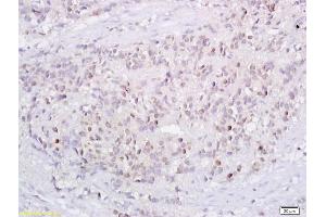 Formalin-fixed and paraffin embedded human endometrium tissue labeled with Anti-P73 Polyclonal Antibody, Unconjugated (ABIN675279) followed by conjugation to the secondary antibody and DAB staining (Tumor Protein p73 抗体  (AA 501-631))