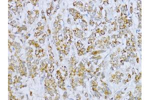 Immunohistochemistry of paraffin-embedded Human colon carcinoma using Aconitase 2  antibody (ABIN1678537, ABIN3017991, ABIN3017992 and ABIN6220329) at dilution of 1:100 (40x lens). (ACO2 抗体  (AA 501-780))