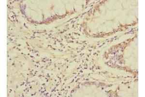 Immunohistochemistry of paraffin-embedded human colon cancer using ABIN7174422 at dilution of 1:100 (UBAP1 抗体  (AA 1-300))