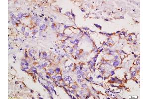 Formalin-fixed and paraffin embedded human lung carcinoma labeled with Rabbit Anti-CCR6/CD196 Polyclonal Antibody, Unconjugated  at 1:200 followed by conjugation to the secondary antibody and DAB staining (CCR6 抗体  (AA 201-300))