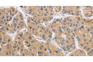 Immunohistochemistry of paraffin-embedded Human liver cancer using ARHGAP15 Polyclonal Antibody at dilution of 1:50 (ARHGAP15 抗体)