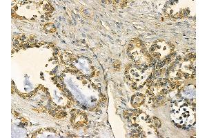 FAS Mouse Monoclonal Antibody at 1/100 staining human ovarian cancer by IHC-P. (FAS 抗体  (C-Term))