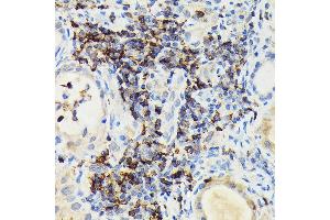 Immunohistochemistry of paraffin-embedded human thyroid cancer using PIK3CG Rabbit pAb (ABIN6130600, ABIN6145638, ABIN6145639 and ABIN6222396) at dilution of 1:100 (40x lens). (PIK3 gamma 抗体  (AA 1-200))