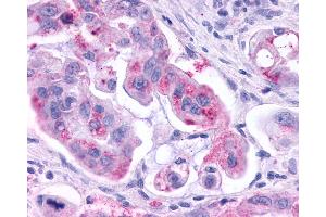Anti-KISS1R / GPR54 antibody IHC of human Pancreas, Carcinoma. (KISS1R 抗体  (N-Term))