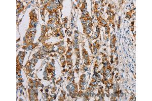 Immunohistochemistry of Human breast cancer using IFITM3 Polyclonal Antibody at dilution of 1:20 (IFITM3 抗体)