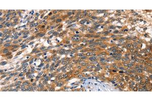 Immunohistochemistry of paraffin-embedded Human cervical cancer tissue using AGO1 Polyclonal Antibody at dilution 1:40 (AGO1 抗体)