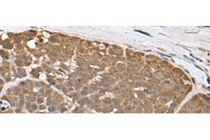 Immunohistochemistry of paraffin-embedded Human thyroid cancer tissue using SPRTN Polyclonal Antibody at dilution of 1:65(x200) (Spartan 抗体)