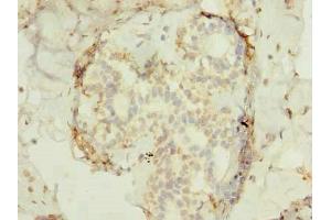 Immunohistochemistry of paraffin-embedded human breast cancer using ABIN7165522 at dilution of 1:100 (FAM53B 抗体  (AA 1-305))