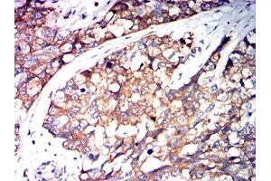 Immunohistochemical analysis of paraffin-embedded bladder cancer tissues using SERPINA1 mouse mAb with DAB staining. (SERPINA1 抗体  (AA 269-419))
