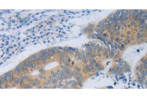 Immunohistochemistry of paraffin-embedded Human colon cancer tissue using MT2A Polyclonal Antibody at dilution 1:40 (MT2A 抗体)