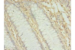 Immunohistochemistry of paraffin-embedded human colon cancer using ABIN7142391 at dilution of 1:100 (MRPL3 抗体  (AA 201-348))