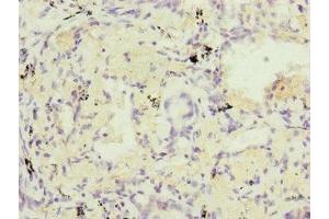 Immunohistochemistry of paraffin-embedded human lung cancer using ABIN7164323 at dilution of 1:100 (RARS2 抗体  (AA 17-340))