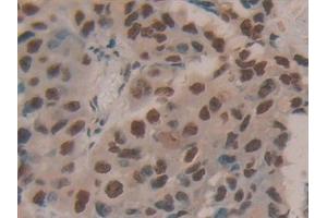 Detection of HDGF in Human Breast cancer Tissue using Polyclonal Antibody to Hepatoma Derived Growth Factor (HDGF) (HDGF 抗体  (AA 10-240))