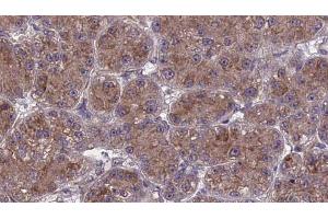 ABIN6273982 at 1/100 staining Human liver cancer tissue by IHC-P. (OR2T27 抗体  (Internal Region))