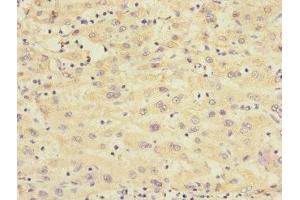 Immunohistochemistry of paraffin-embedded human liver cancer using ABIN7167664 at dilution of 1:100 (Relaxin 3 Receptor 1 抗体  (AA 1-80))