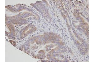 IHC-P Image Immunohistochemical analysis of paraffin-embedded human T(gastric cancer) , using NSMAF, antibody at 1:100 dilution. (NSMAF 抗体)