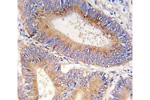 IHC analysis of FFPE human colon carcinoma tissue stained with GDF11 antibody (GDF11 抗体  (AA 32-61))