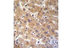 Immunohistochemistry analysis in formalin fixed and paraffin embedded human liver tissue reacted with GAGE12B Antibody (N-term) followed by peroxidase conjugation of the secondary antibody and DAB staining. (G Antigen 12B 抗体  (N-Term))