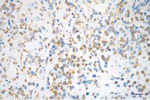 Immunohistochemistry was performed on paraffin-embedded human glioblastoma using QKI antibody (ABIN7800036), 1:200). (Recombinant QKI 抗体)