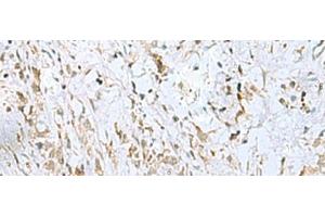 Immunohistochemistry of paraffin-embedded Human gastric cancer tissue using ECT2 Polyclonal Antibody at dilution of 1:35(x200) (ECT2 抗体)