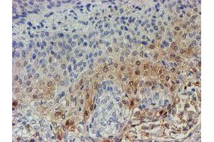 Immunohistochemical staining of paraffin-embedded Carcinoma of Human bladder tissue using anti-C17orf37 mouse monoclonal antibody. (C17orf37 抗体)