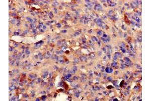 Immunohistochemistry of paraffin-embedded human melanoma using ABIN7169242 at dilution of 1:100 (PPP2R2A 抗体  (Regulatory Subunit B))