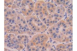 Detection of DNASE1 in Human Liver cancer Tissue using Polyclonal Antibody to Deoxyribonuclease I (DNASE1) (DNASE1 抗体  (AA 19-259))