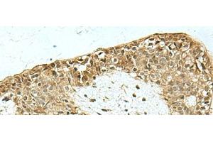 Immunohistochemistry of paraffin-embedded Human breast cancer tissue using KAT7 Polyclonal Antibody at dilution of 1:55(x200) (MYST2 抗体)
